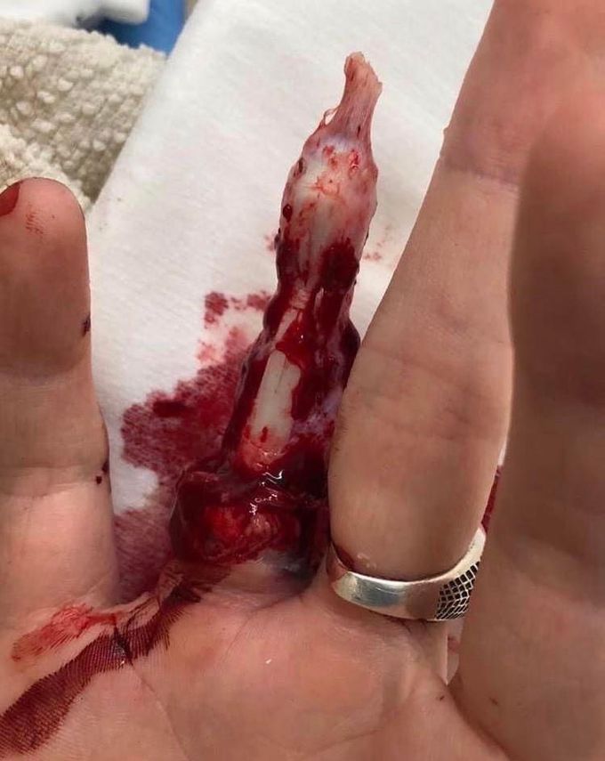 Ring finger degloving after getting it caught on a fence! ⚠️