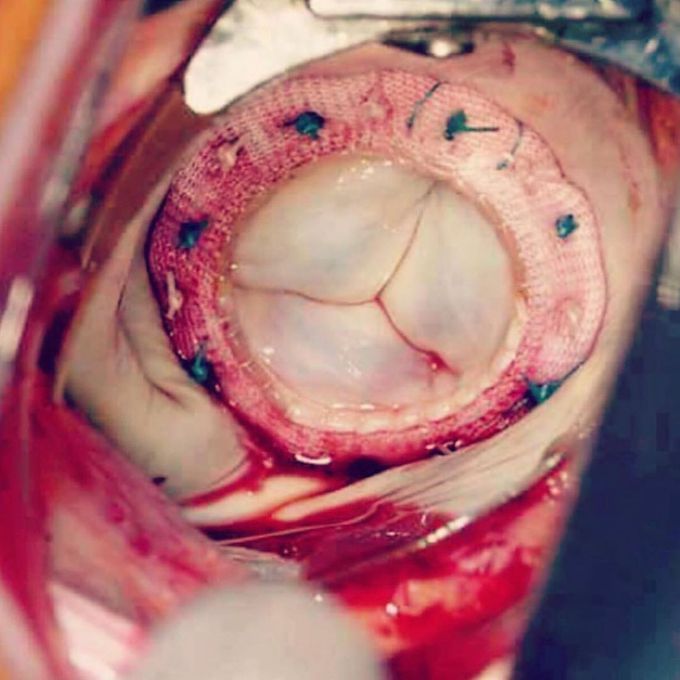 Tricuspid valve