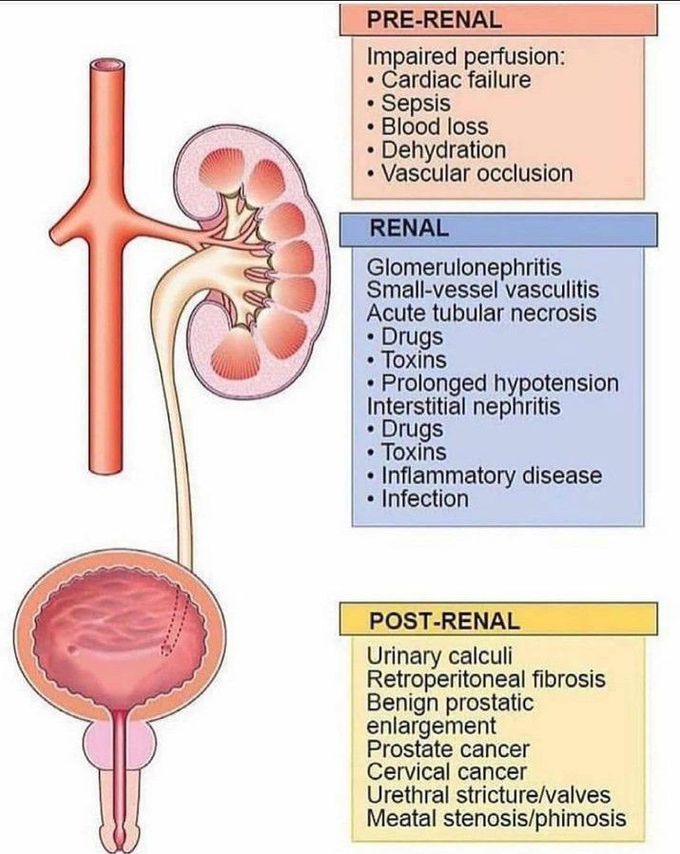 Causes of renal failure