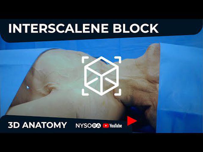 Interscalene Block