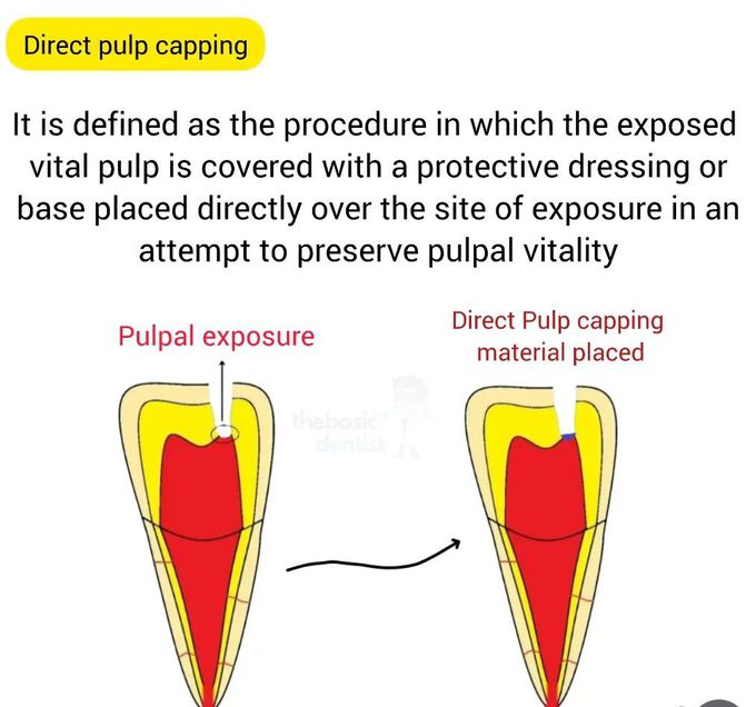 Pulp Capping III