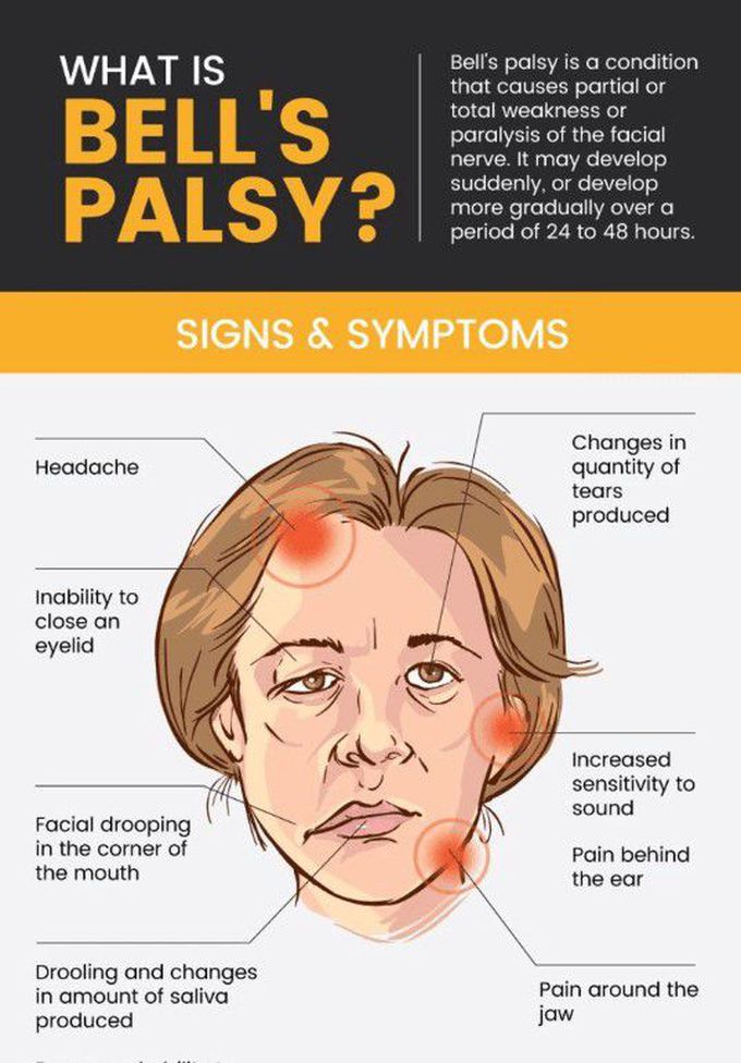 Symptoms of Bell's Palsy