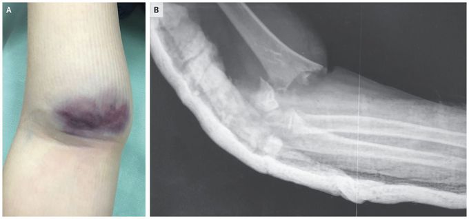 Supracondylar Fracture