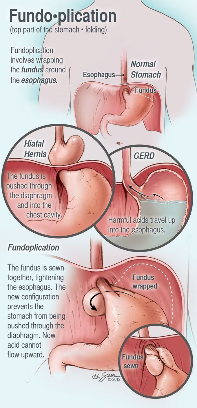 Very clear infographic about Fundoplication👌🏻