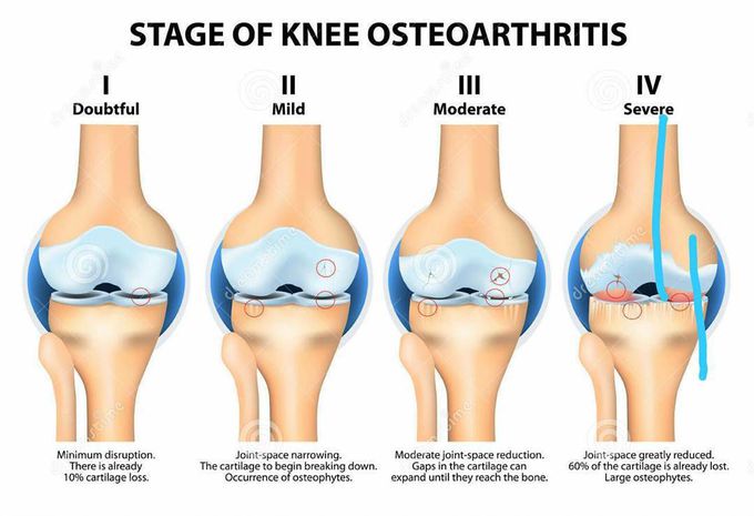 Knee Osteoarthritis