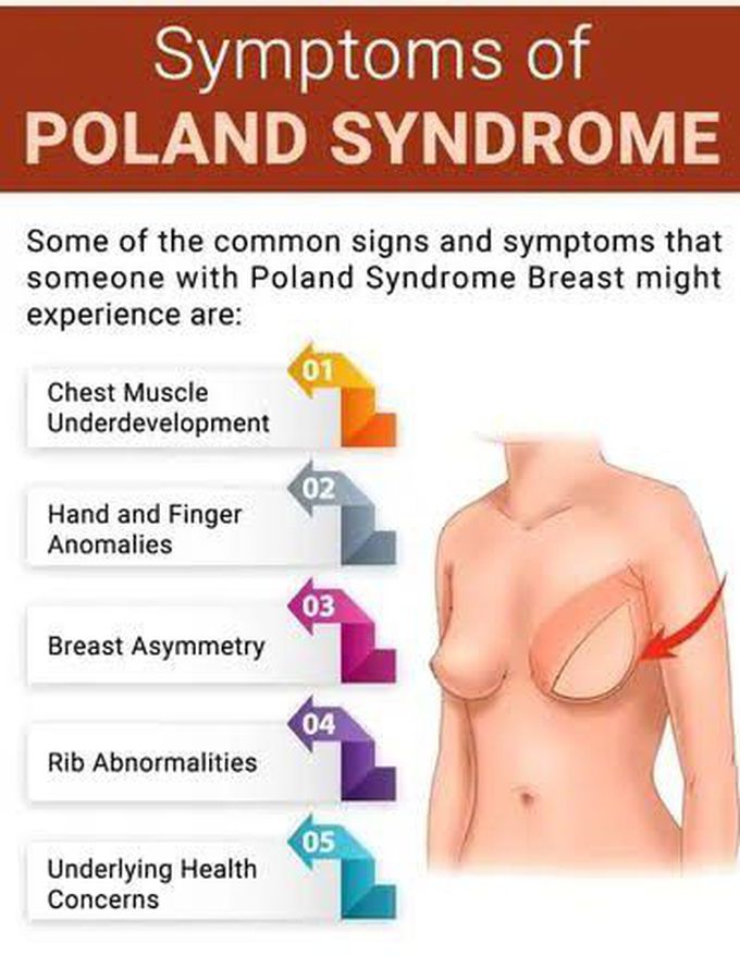 Poland Syndrome