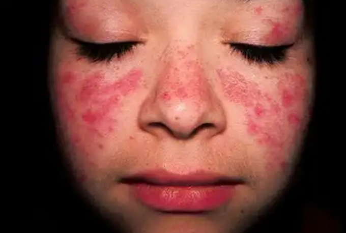 SKIN DISEASES