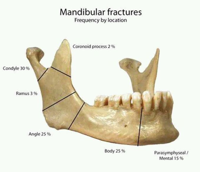 Mandibular fractures
