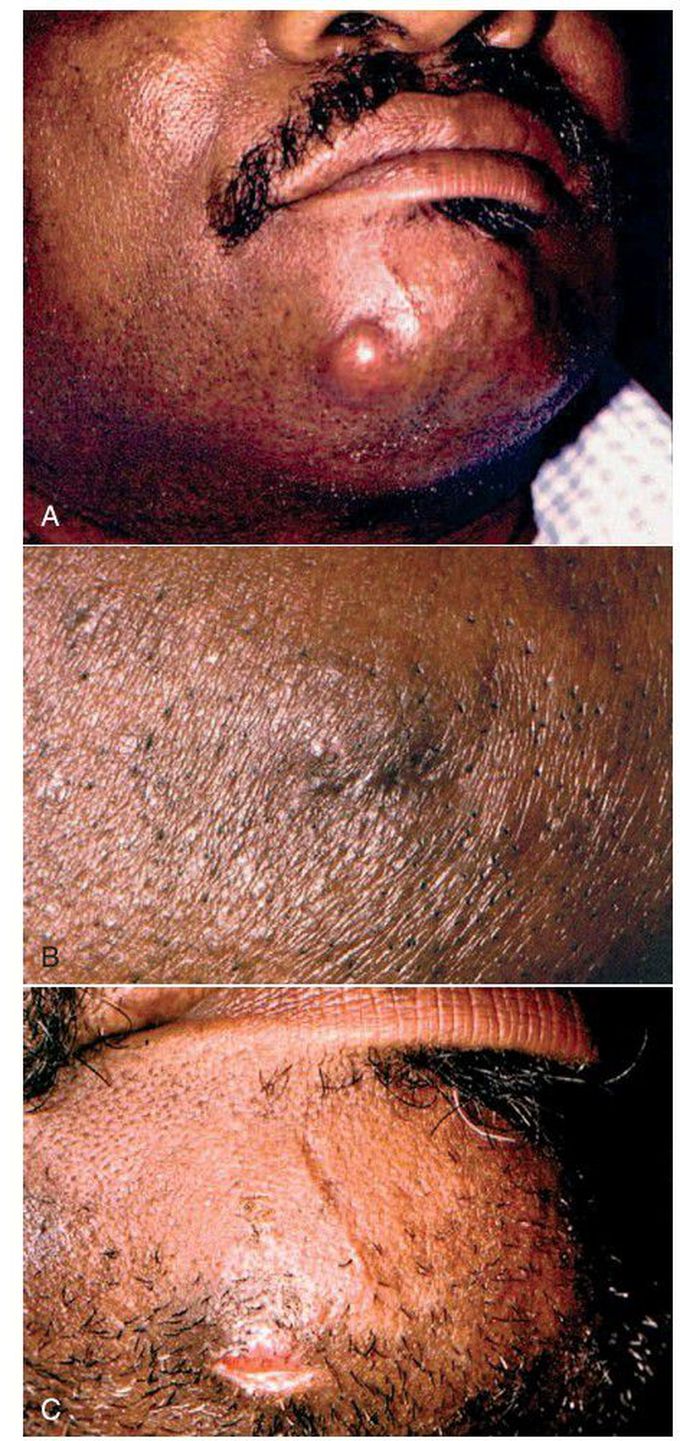 Odontogenic infection