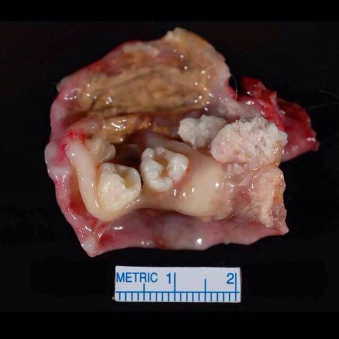 Dermoid Cyst - MEDizzy