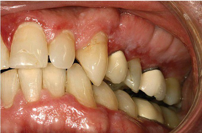 Foreign Body Gingivitis