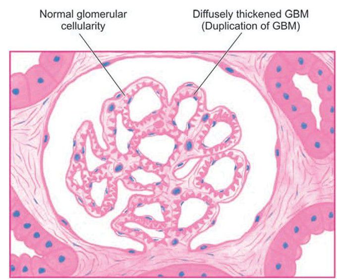 Membranous GN, light microscopic appearance.