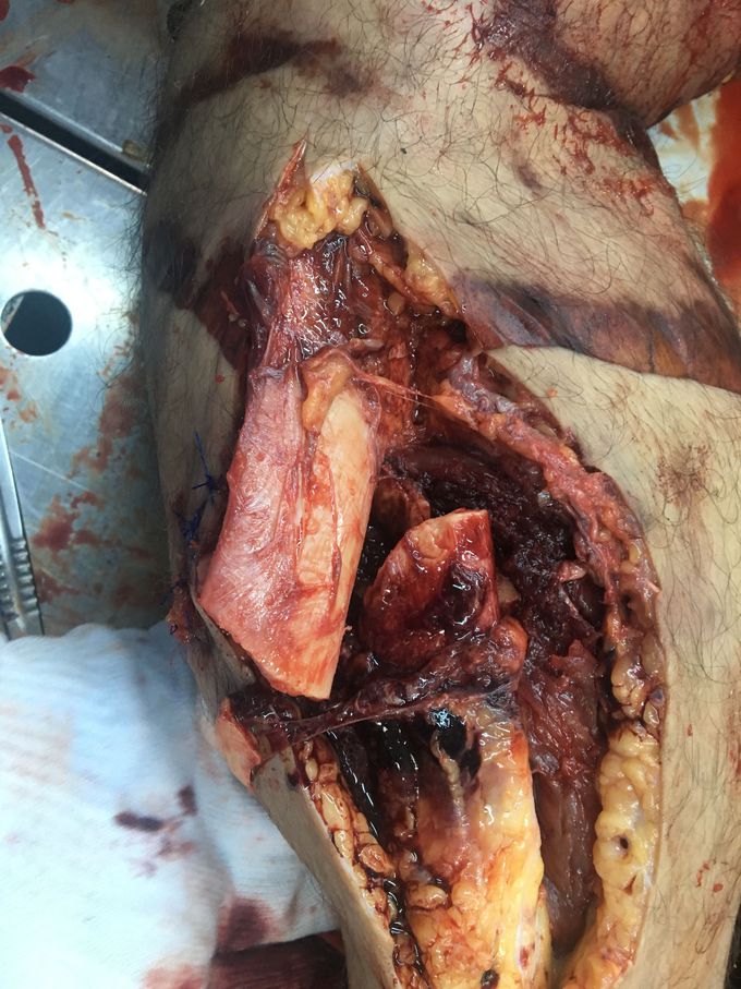Open tibia fracture