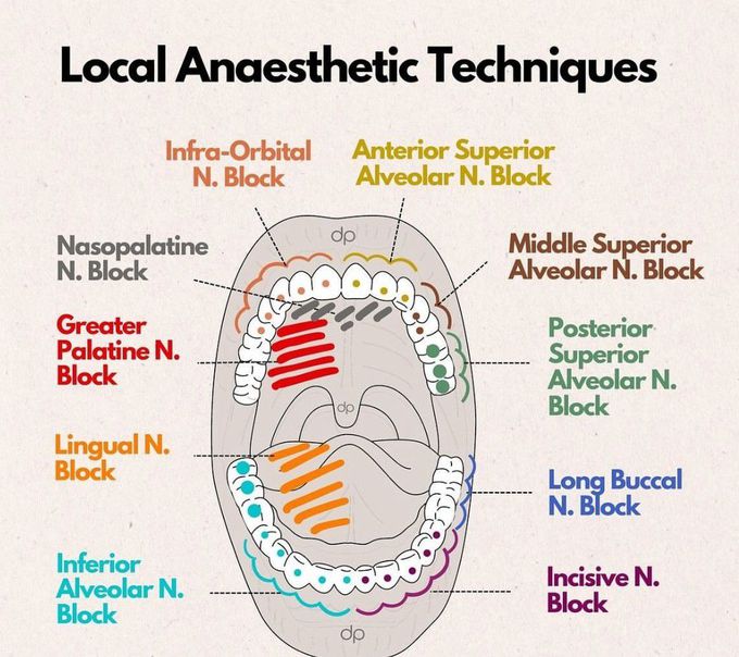 Local Anesthesia Techniques