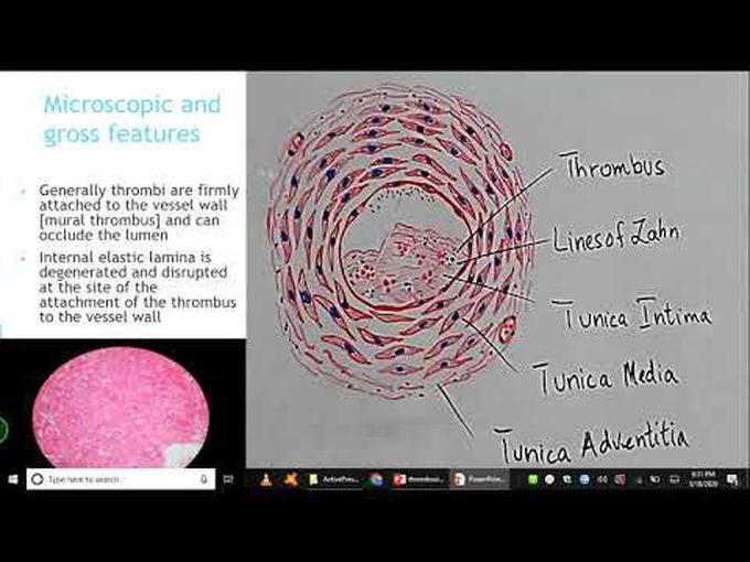 Thrombosis