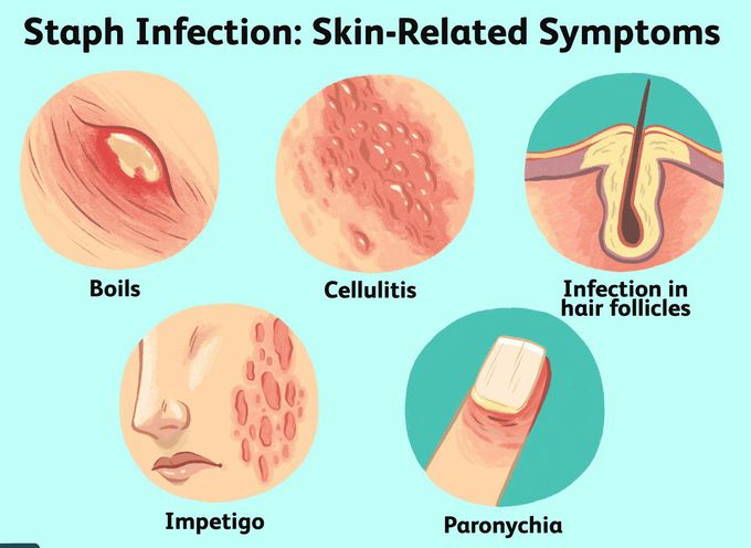 Staphylococcus infection