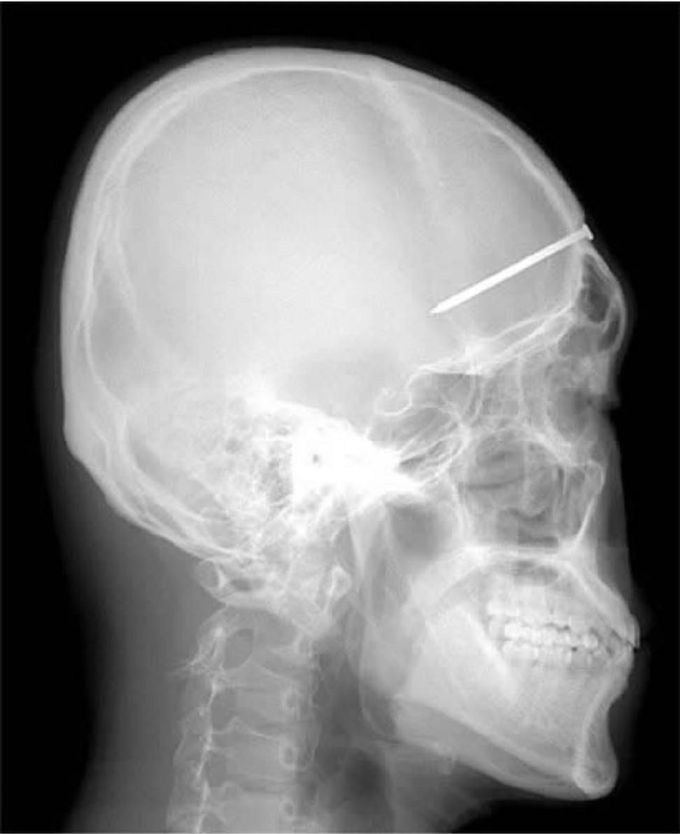 The 5-centimeter nail shown in this X-ray was found after a man came to hospital complaining of a severe headache