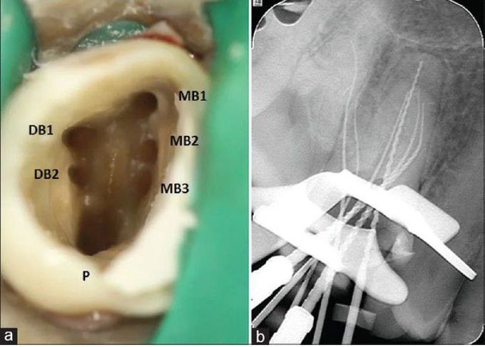 Molar with Six Roots