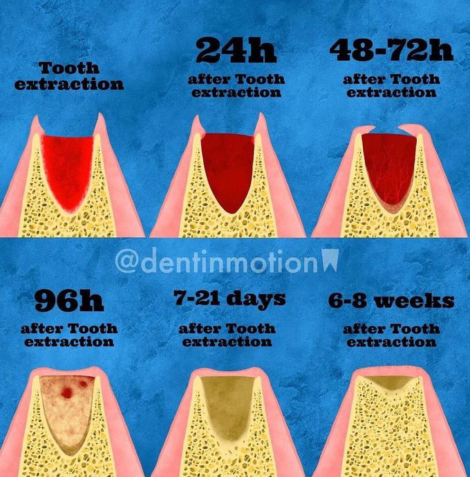 Healing Of Extraction Wound