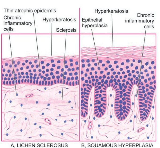 Epithelial disorder