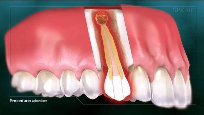 Apicoectomy