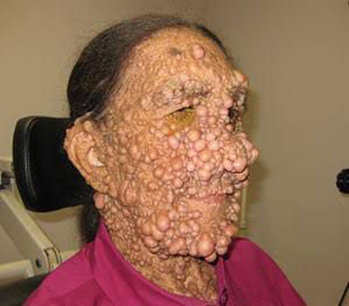 Neurofibromatosis