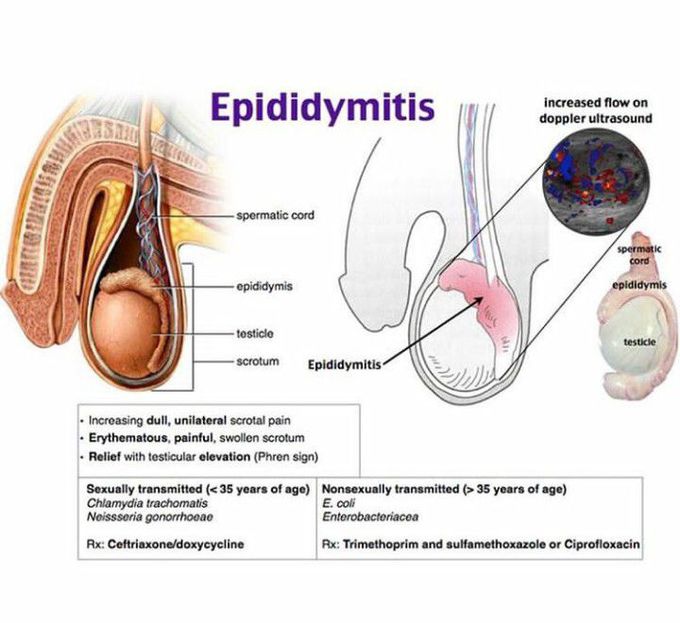 Epididymitis