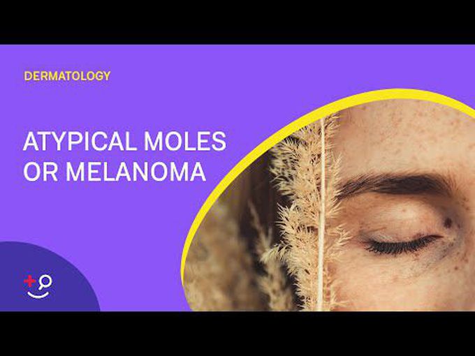 What is the ABCDE rule of melanoma?