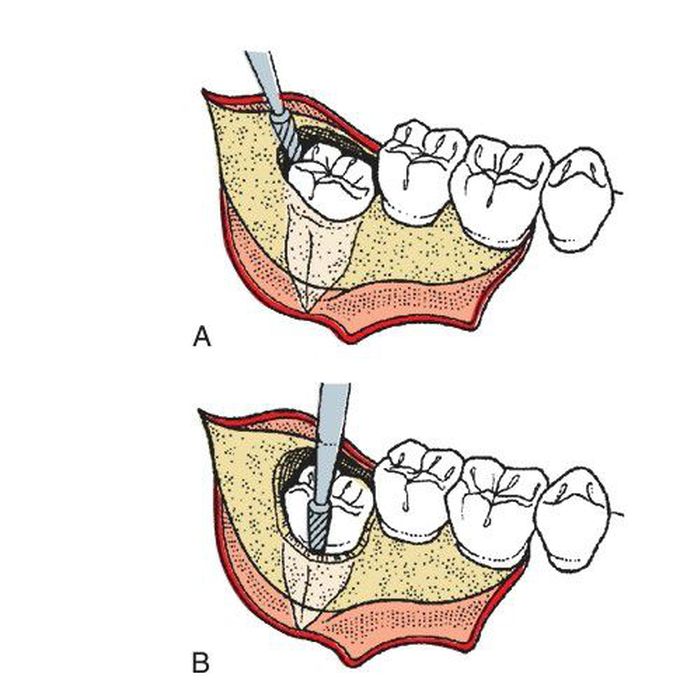 Extraction of impacted tooth