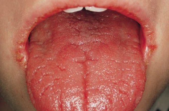 Oral symptoms of plasma cell gingivitis