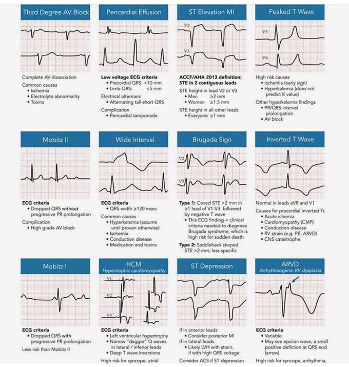 Arrhythmia