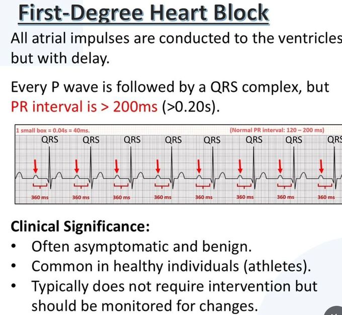Heart Block III