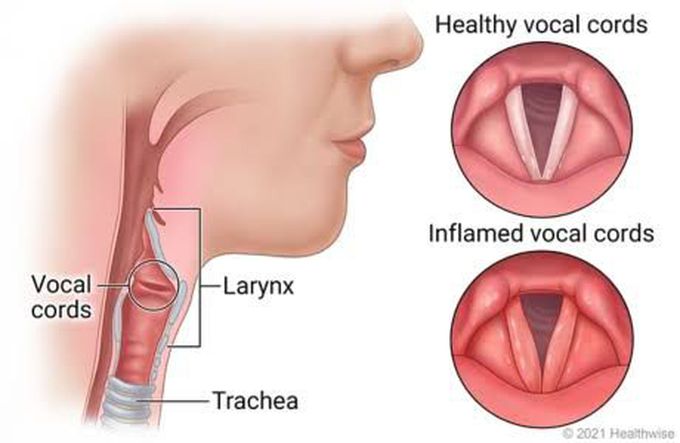 How to prevent laryngitis?