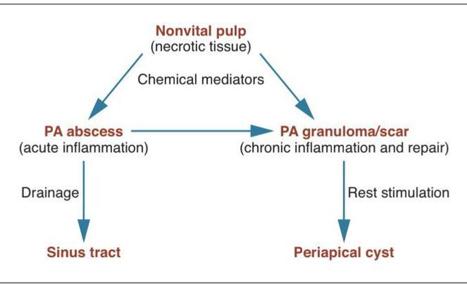 Pathogenesis of periapical infection