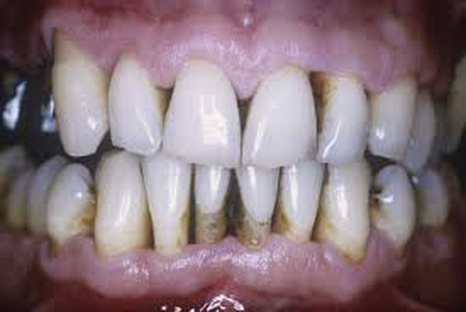 Periodontitis