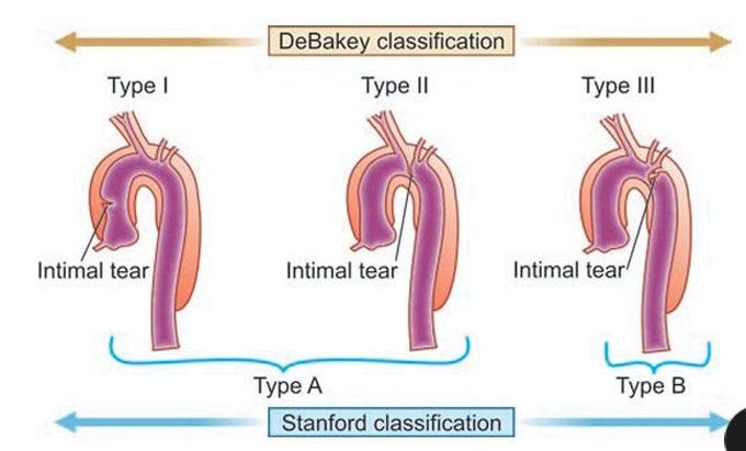 Thoracic aortic dissection