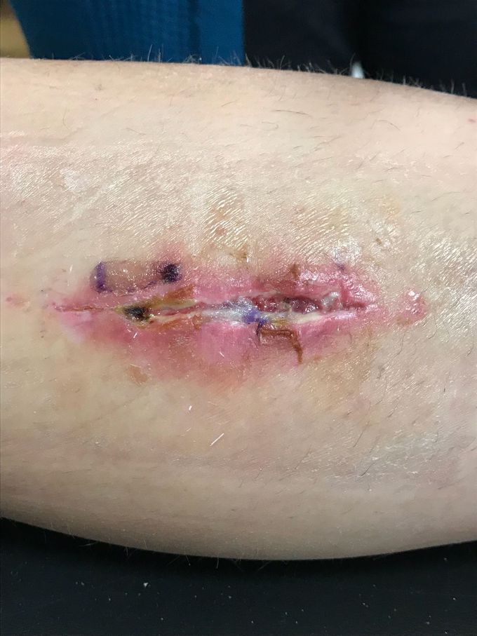 Infected or still healing???