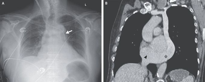 Isolated Persistent Left Superior Vena Cava