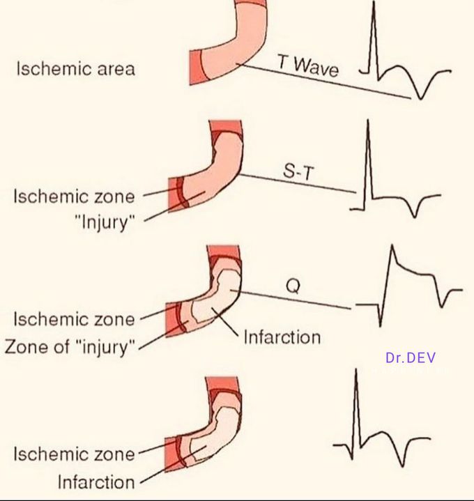 ECG CHANGE IN ISCHEMIC INJURY