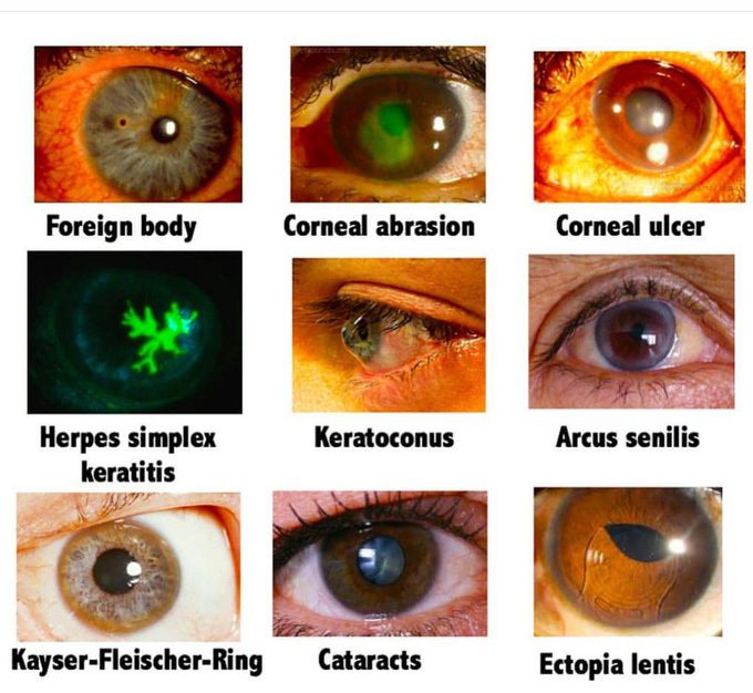 Eye disease