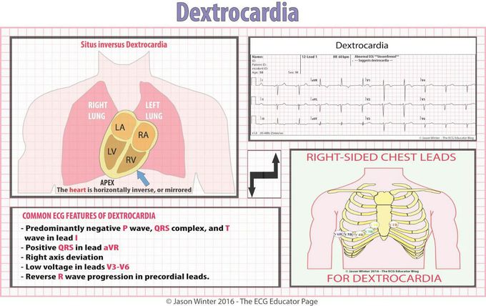 Dextrocardia