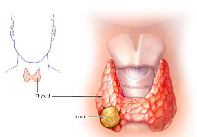 Cancer - Thyroid