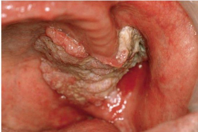 Verrucous carcinoma