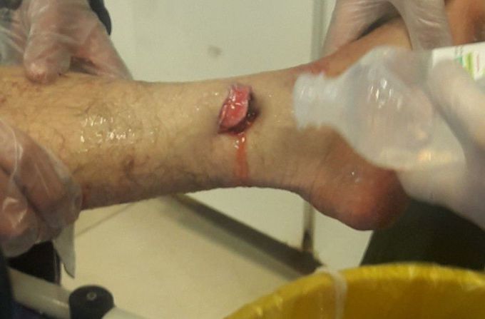 Open fracture