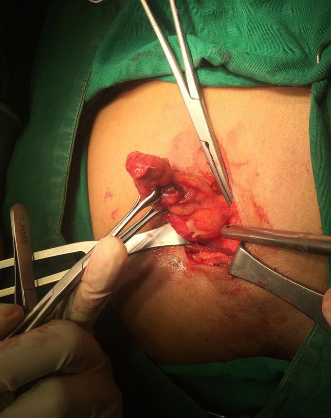 Abdominal tonsil