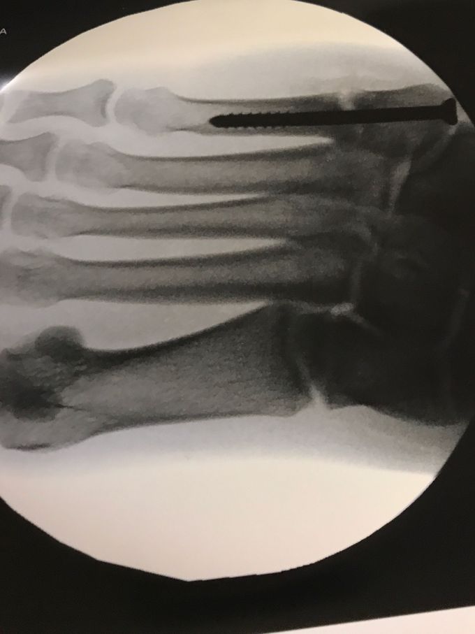 5th-metatarsal-repair-surgery-medizzy