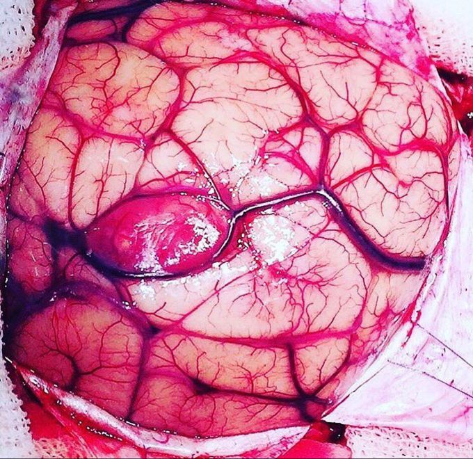 Glioblastoma