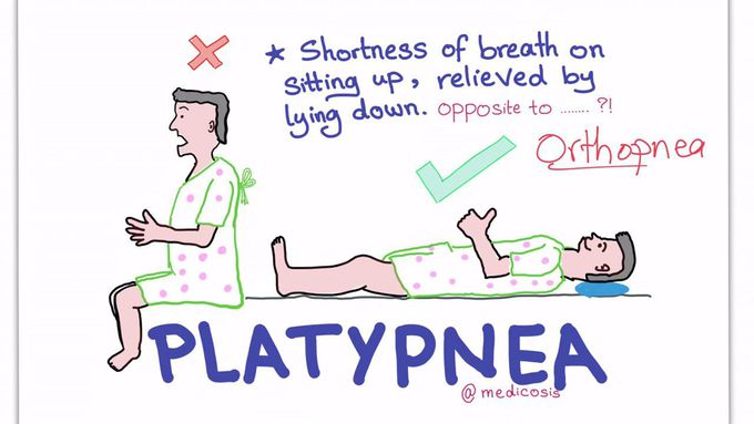 Platypnea-Orthodeoxia Syndrome