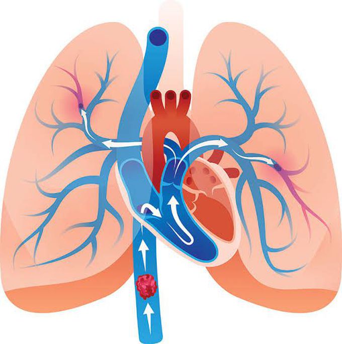 Pulmonary embolus