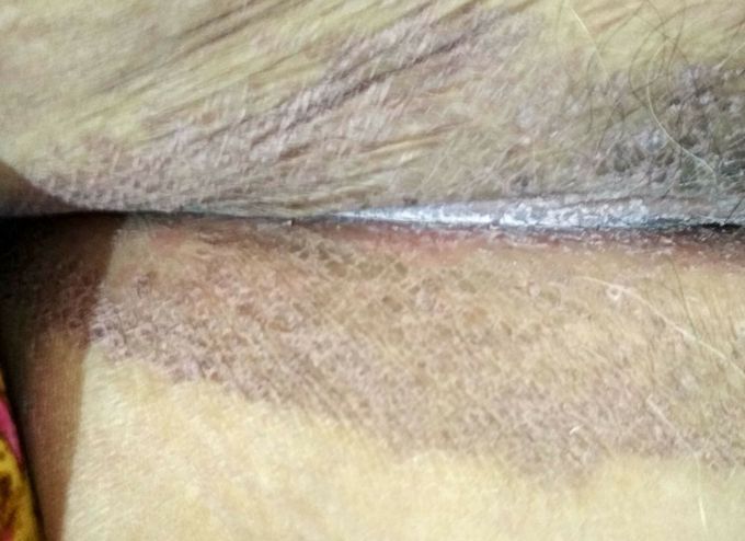 Skin lesion